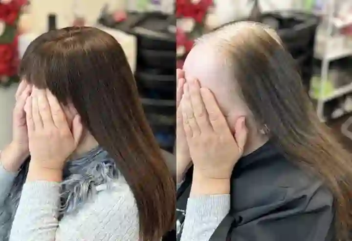 Hair Replacement Treatment Norfolk