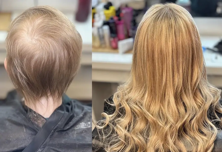 Hair Replacement Treatment Norfolk